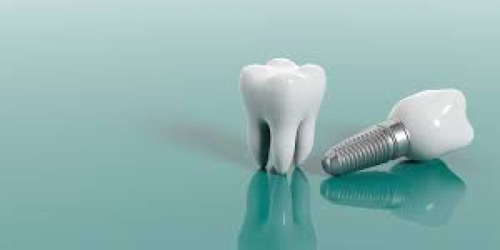 Recupera tu sonrisa. Clínica dental Dr David Martinez
